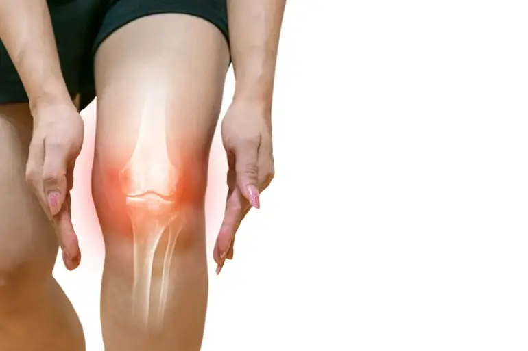 Kopott térdízületi porc és arthrosisra jellemző csontkinövések illusztrációja
